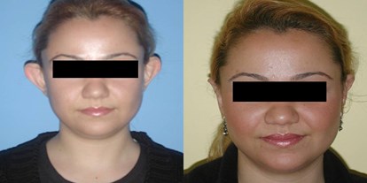 Schönheitskliniken - Tränensäcke entfernen - Ohrkorrektur - Cevre Hospital Istanbul