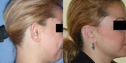 Schönheitskliniken - Stirnlifting - Türkei - Ohrkorrektur - Cevre Hospital Istanbul