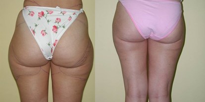 Schönheitskliniken - Liposuction - Cevre Hospital Istanbul