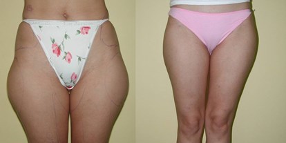 Schönheitskliniken - Fettabsaugung - Türkei - Liposuction - Cevre Hospital Istanbul