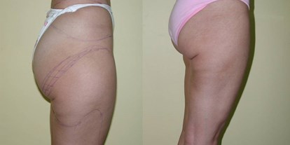 Schönheitskliniken - Gesäßstraffung - Türkei West - Liposuction - Cevre Hospital Istanbul