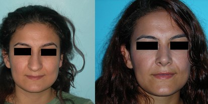 Schönheitskliniken - Haartransplantation - Türkei - Nasenkorrektur - Cevre Hospital Istanbul