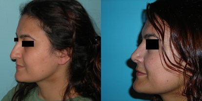 Schönheitskliniken - Lippenvergrößerung - Schwarzes Meer - Westtürkei - Nasenkorrektur - Cevre Hospital Istanbul