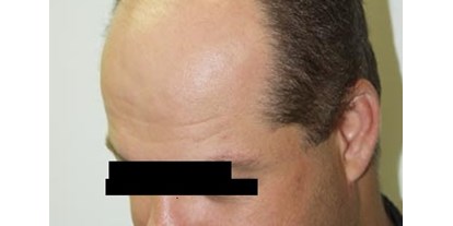 Schönheitskliniken - Stirnlifting - Türkei - Haartransplantation - Cevre Hospital Istanbul