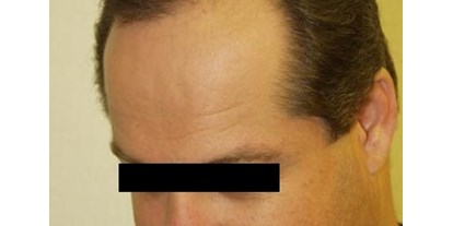 Schönheitskliniken - Stirnlifting - Haartransplantation - Cevre Hospital Istanbul