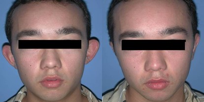 Schönheitskliniken - Augenringe entfernen - Schwarzes Meer - Westtürkei - Ohrkorrektur - Cevre Hospital Istanbul
