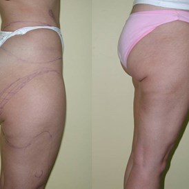Schoenheitsklinik: Liposuction - Cevre Hospital Istanbul