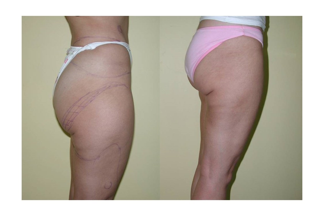 Schoenheitsklinik: Liposuction - Cevre Hospital Istanbul