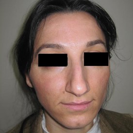 Schoenheitsklinik: Nasenkorrektur - Cevre Hospital Istanbul