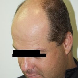 Schoenheitsklinik: Haartransplantation - Cevre Hospital Istanbul