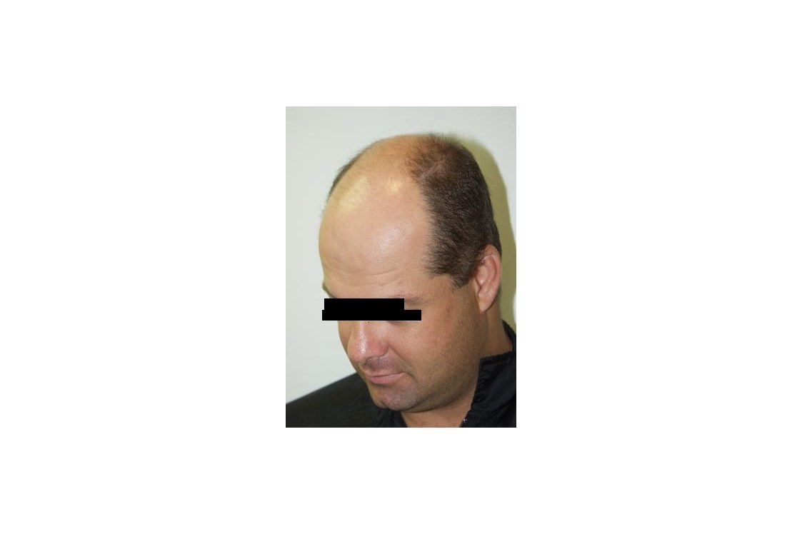 Schoenheitsklinik: Haartransplantation - Cevre Hospital Istanbul
